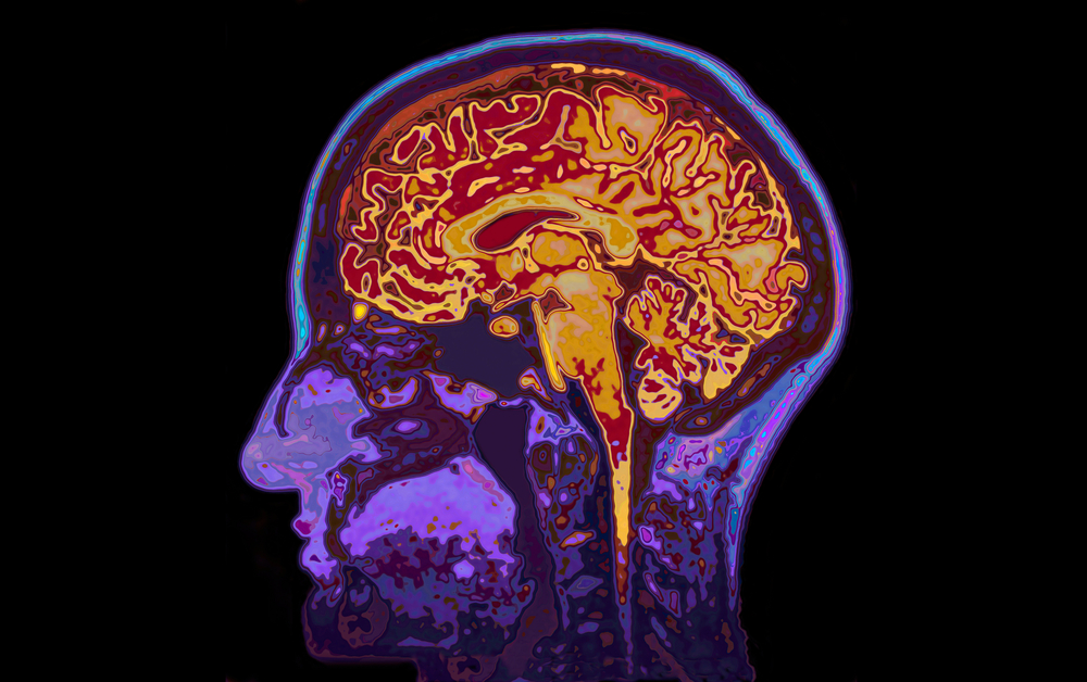 L'intelligenza non è nata nel cervello. mri,image,of,head,showing,brain